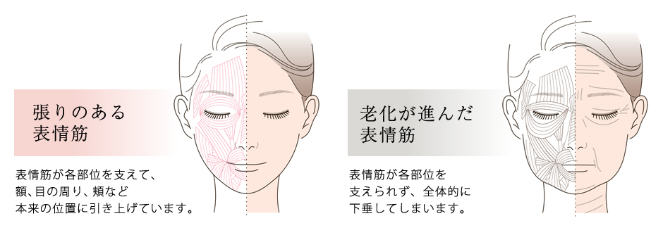 張りのある表情筋　表情筋が各部位を支えて、額、目の周り、頬など本来の位置に引き上げています。　老化が進んだ表情筋 表情筋が各部位を支えられず、全体的に下垂してしまいます。