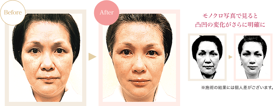 ほうれい線のBefore→After｜モノクロ写真で見ると凸凹の変化がさらに明確 ※施術の結果には個人差がございます。